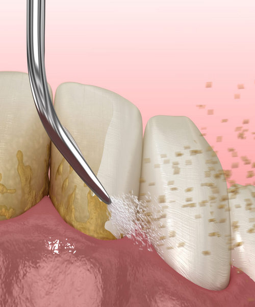 Dentalni Aparat Za Čišćenje Zubnog Kamenca 66