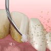 Dentalni Aparat Za Čišćenje Zubnog Kamenca 66