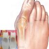 Štitnik Za Čukljeve Anatomski Hallux Valgus 3