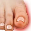 Štitnik Za Čukljeve Anatomski Hallux Valgus 4