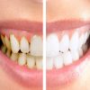Dentalni Aparat Za Čišćenje Zubnog Kamenca 22