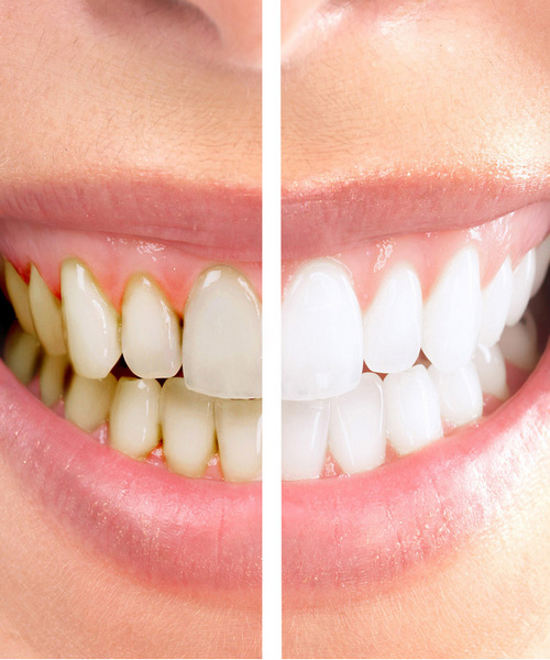 Dentalni Aparat Za Čišćenje Zubnog Kamenca 22